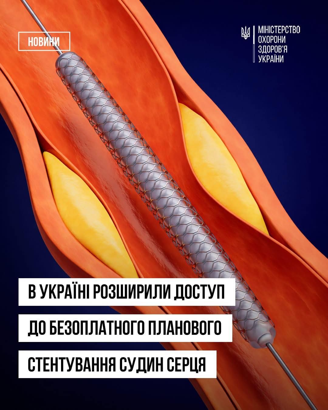 Планове стентування судин безоплатне для мешканців Закарпаття